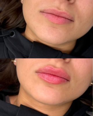 اصلاح خط لبخند